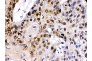 TCF7L1 was detected in paraffin-embedded sections of human oesophagus squama cancer tissues using rabbit anti- TCF7L1 Antigen Affinity purified polyclonal antibody at 1 μg/mL. (TCF7L1 Antikörper  (C-Term))