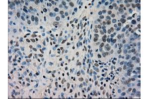 Immunohistochemical staining of paraffin-embedded Adenocarcinoma of breast tissue using anti-DHFR mouse monoclonal antibody. (Dihydrofolate Reductase Antikörper)