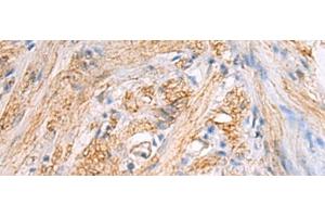 Immunohistochemistry of paraffin-embedded Human gastric cancer tissue using TMOD3 Polyclonal Antibody at dilution of 1:70(x200) (TMOD3 Antikörper)