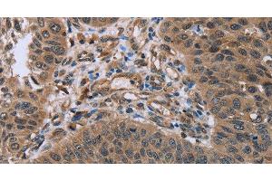 Immunohistochemistry of paraffin-embedded Human lung cancer using HOMER1 Polyclonal Antibody at dilution of 1:50 (HOMER1 Antikörper)