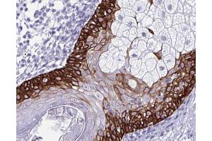 ABIN6266574 at 1/100 staining human colon cancer tissue by IHC-P. (Cytokeratin 5 Antikörper  (C-Term))