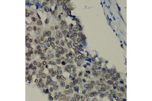 Immunohistochemistry of paraffin-embedded human lung cancer using TEAD1 antibody at dilution of 1:100 (x40 lens). (TEAD1 Antikörper)