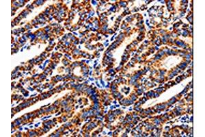 The image is immunohistochemistry of paraffin-embedded Human thyroid cancer tissue using ABIN7129012(COX19 Antibody) at dilution 1/50.