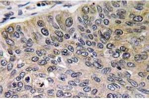 Immunohistochemistry (IHC) analyzes of Cathepsin E antibody in paraffin-embedded human lung carcinoma tissue.