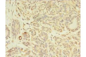 Immunohistochemistry of paraffin-embedded human breast cancer using ABIN7163630 at dilution of 1:100 (PDGFRB Antikörper  (AA 901-1106))