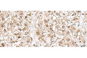 Immunohistochemistry of paraffin-embedded Human liver cancer tissue using RPL35 Polyclonal Antibody at dilution of 1:70(x200)