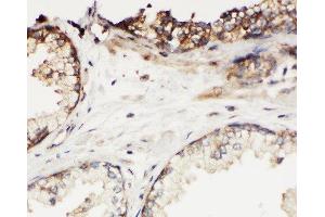 Anti-Kallikrein 11 antibody, IHC(P) IHC(P): Human Prostatic Cancer Tissue (Kallikrein 11 Antikörper  (C-Term))