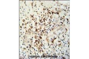 HAUS5 Antibody (N-term) (ABIN651423 and ABIN2840230) immunohistochemistry analysis in formalin fixed and paraffin embedded human colon carcinoma followed by peroxidase conjugation of the secondary antibody and DAB staining. (HAUS5 Antikörper  (N-Term))