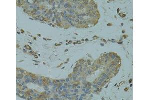 Immunohistochemistry of paraffin-embedded Human breast cancer using DGKQ Polyclonal Antibody at dilution of 1:100 (40x lens). (DGKQ Antikörper)