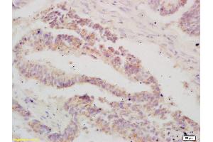 Formalin-fixed and paraffin embedded human colon carcinoma labeled with Anti-ATF3 Polyclonal Antibody, Unconjugated (ABIN669561) at 1:200 followed by conjugation to the secondary antibody and DAB staining