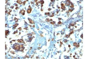 Formalin-fixed, paraffin-embedded human Gastric Carcinoma stained with MUC3 Mouse Monoclonal Antibody (M3. (MUC3A Antikörper)