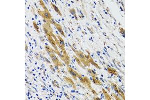 Immunohistochemistry of paraffin-embedded human liver cancer using PLA2G2D antibody (ABIN5974036) at dilution of 1/100 (40x lens). (PLA2G2D Antikörper)