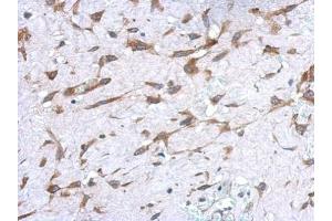 IHC-P Image Immunohistochemical analysis of paraffin-embedded human hepatoma, using UGT1A, antibody at 1:500 dilution. (Ugt1 Antikörper)
