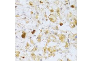 Immunohistochemistry of paraffin-embedded human brain astrocytoma using FCN1 Antibody (ABIN2562567) at dilution of 1:100 (40x lens). (FCN1 Antikörper)