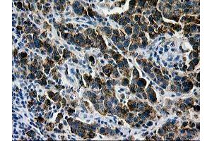 Immunohistochemical staining of paraffin-embedded Carcinoma of Human lung tissue using anti-LGALS3BP mouse monoclonal antibody. (LGALS3BP Antikörper  (AA 19-300))