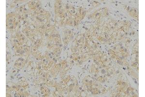 ABIN6272934 at 1/100 staining Human breast cancer tissue by IHC-P. (STING/TMEM173 Antikörper  (Internal Region))