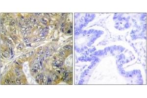 Immunohistochemistry analysis of paraffin-embedded human colon carcinoma tissue, using EPS8L3 Antibody. (EPS8-Like 3 Antikörper  (AA 401-450))