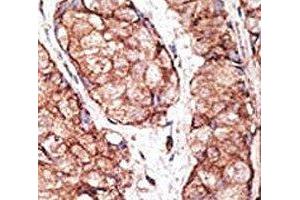 IHC analysis of FFPE human breast carcinoma tissue stained with the TLR5 antibody (TLR5 Antikörper  (AA 71-102))