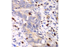 Immunohistochemistry of paraffin-embedded human gastric cancer using S100A12 antibody (ABIN6291358) at dilution of 1:100 (40x lens). (S100A12 Antikörper)