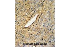 CEP63 Antibody (Center) (ABIN651000 and ABIN2840033) IHC analysis in formalin fixed and paraffin embedded prostate carcinoma followed by peroxidase conjugation of the secondary antibody and DAB staining. (CEP63 Antikörper  (AA 520-548))