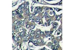 IHC analysis of formalin fixed paraffin embedded human breast carcinoma stained with EIF4E2 antibody (EIF4E2 Antikörper  (AA 12-41))