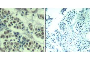 Immunohistochemical analysis of paraffin-embedded human breast carcinoma tissue using MDM2 (Ab-166) Antibody (E021550). (MDM2 Antikörper)