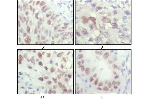 Immunohistochemical analysis of paraffin-embedded human lung carcinoma (A), liver carcinoma (B), breast carcinoma (C) and kiney carcinoma (D), showing nuclear localization with DAB staining using CHK2 antibody. (CHEK2 Antikörper  (AA 481-531))