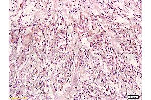 Formalin-fixed and paraffin embedded: human endometrium tissue labeled with Anti-KRAS Polyclonal Antibody (ABIN736671), Unconjugated at 1:200, followed by conjugation to the secondary antibody and DAB staining (K-RAS Antikörper  (AA 25-130))