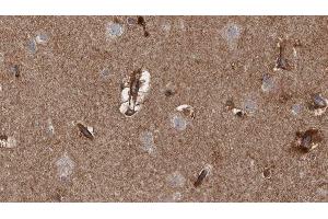 ABIN6279767 at 1/100 staining Human brain cancer tissue by IHC-P. (ARHGAP20 Antikörper  (Internal Region))