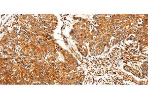 Immunohistochemistry of paraffin-embedded Human esophagus cancer using TPM2 Polyclonal Antibody at dilution of 1:30 (TPM2 Antikörper)
