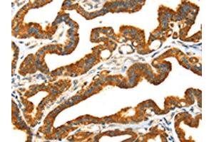 The image on the left is immunohistochemistry of paraffin-embedded Human thyroid cancer tissue using ABIN7192030(PRSS50 Antibody) at dilution 1/30, on the right is treated with synthetic peptide. (MASP1 Antikörper)
