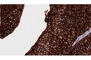 ABIN6268889 at 1/100 staining Human urothelial cancer tissue by IHC-P. (FAS Antikörper  (C-Term))