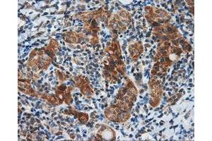 Immunohistochemical staining of paraffin-embedded Carcinoma of liver tissue using anti-SIL1 mouse monoclonal antibody. (SIL1 Antikörper)