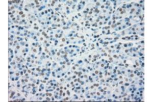 Immunohistochemical staining of paraffin-embedded Carcinoma of kidney tissue using anti-MAP2K4mouse monoclonal antibody. (MAP2K4 Antikörper)