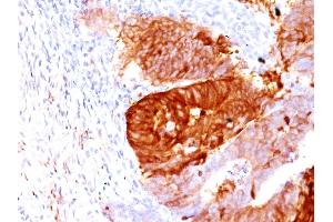 Formalin-fixed, paraffin-embedded human Colon Carcinoma stained with ALDH1A1 Mouse Monoclonal Antibody (ALDH1A1/1381). (ALDH1A1 Antikörper  (AA 315-434))