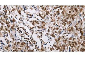 Immunohistochemistry of paraffin-embedded Human esophagus cancer tissue using CMTM2 Polyclonal Antibody at dilution 1:60 (CMTM2 Antikörper)