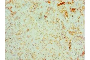 Immunohistochemistry of paraffin-embedded human ovarian cancer using ABIN7158679 at dilution of 1:100 (BRCC3 Antikörper  (AA 14-316))