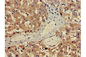 Immunohistochemistry of paraffin-embedded human liver cancer using ABIN7142600 at dilution of 1:100 (ALAS1 Antikörper  (AA 57-285))