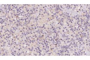 ABIN6273120 at 1/100 staining Human lymph cancer tissue by IHC-P. (HBXIP Antikörper  (Internal Region))
