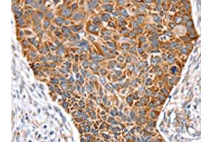 The image on the left is immunohistochemistry of paraffin-embedded Human esophagus cancer tissue using ABIN7131122(SNX11 Antibody) at dilution 1/30, on the right is treated with fusion protein. (SNX11 Antikörper)