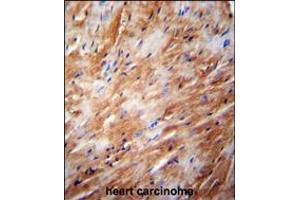 TFB2M Antibody immunohistochemistry analysis in formalin fixed and paraffin embedded human heart carcinoma followed by peroxidase conjugation of the secondary antibody and DAB staining. (TFB2M Antikörper  (C-Term))
