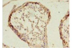 Immunohistochemistry of paraffin-embedded human colon cancer using ABIN7155301 at dilution of 1: 100