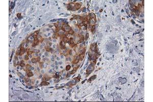 Immunohistochemical staining of paraffin-embedded Adenocarcinoma of Human breast tissue using anti-AK5 mouse monoclonal antibody. (Adenylate Kinase 5 Antikörper)