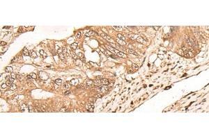 Immunohistochemistry of paraffin-embedded Human colorectal cancer tissue using MAGEA1 Polyclonal Antibody at dilution of 1:65(x200) (MAGEA1 Antikörper)
