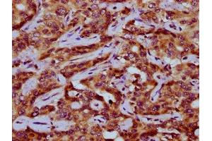 IHC image of ABIN7162965 diluted at 1:200 and staining in paraffin-embedded human liver cancer performed on a Leica BondTM system. (PEX11A Antikörper  (AA 106-219))