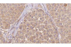 ABIN6273647 at 1/100 staining Human Melanoma tissue by IHC-P.
