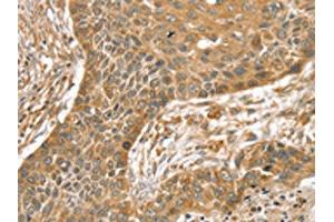 The image on the left is immunohistochemistry of paraffin-embedded Human esophagus cancer tissue using ABIN7192541(SLIT1 Antibody) at dilution 1/35, on the right is treated with synthetic peptide.