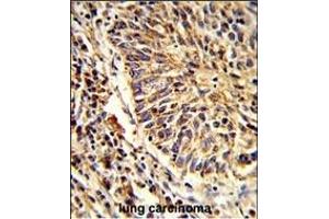 Formalin-fixed and paraffin-embedded human lung carcinoma reacted with AD Antibody (C-term), which was peroxidase-conjugated to the secondary antibody, followed by DAB staining. (ADAM9 Antikörper  (C-Term))