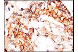 Formalin-fixed and paraffin-embedded human breast carcinoma reacted with anti-APPBP1 Antibody , which was peroxidase-conjugated to the secondary antibody, followed by DAB staining. (NAE1 Antikörper  (C-Term))