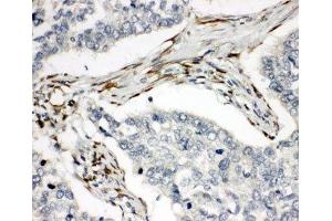 IHC-P: TRAIL R2 antibody testing of human lung cancer tissue (TNFRSF10B Antikörper  (C-Term))